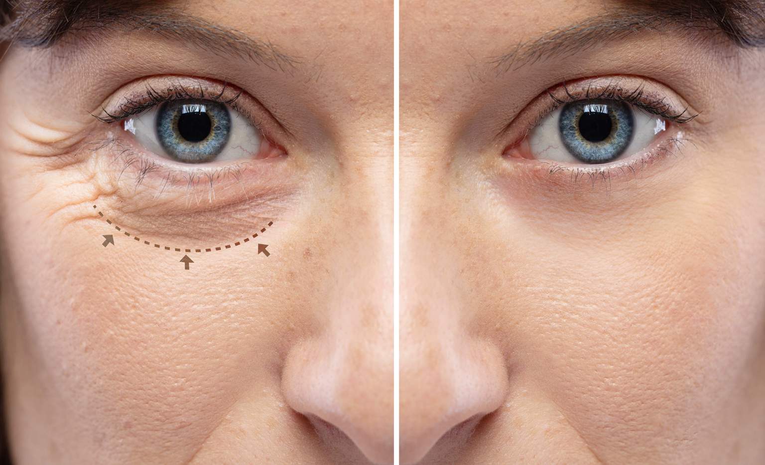 The surprising benefits of baking soda for reducing wrinkles, spots, and dark circles on your face