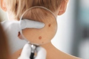 The most effective ways to get rid of neck warts safely